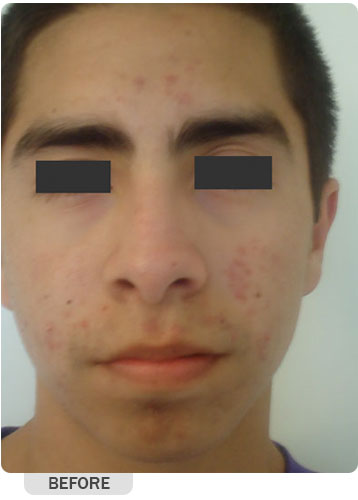 Before Acne Treatment