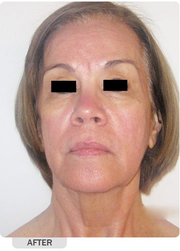 After Anti-Aging Treatment