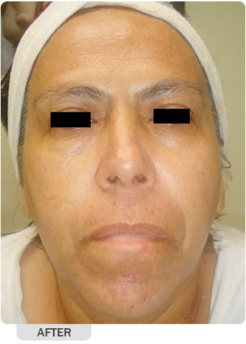 After Hydrafacial