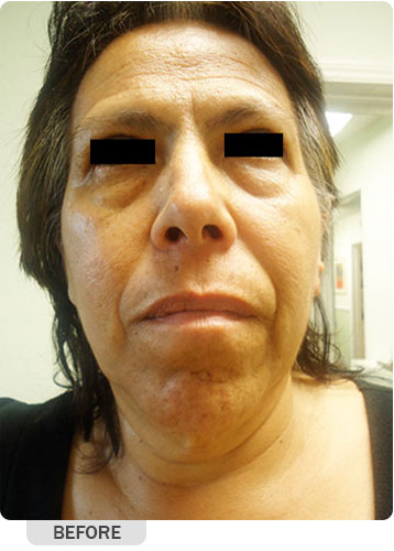 Before Hydrafacial