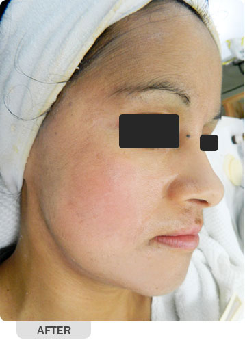 After Hyperpigmentation Treatment