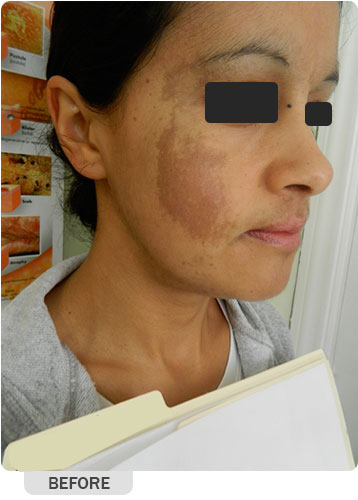 Before Hyperpigmentation Treatment