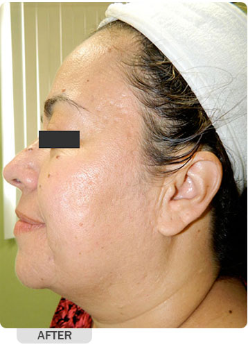 After Microneedling